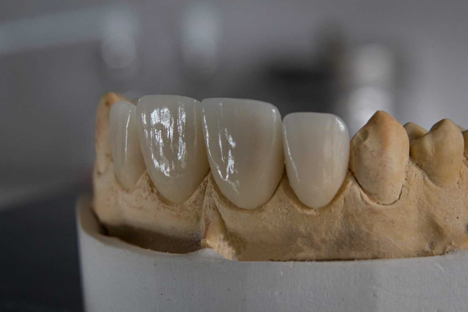 Dental Crowns For Baby Teeth