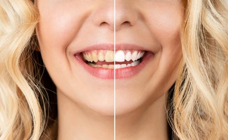 Teeth Whitening