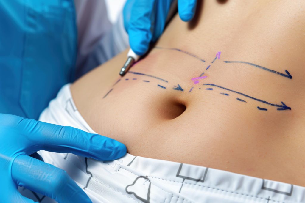 How To Prepare For Tummy Tuck Surgery